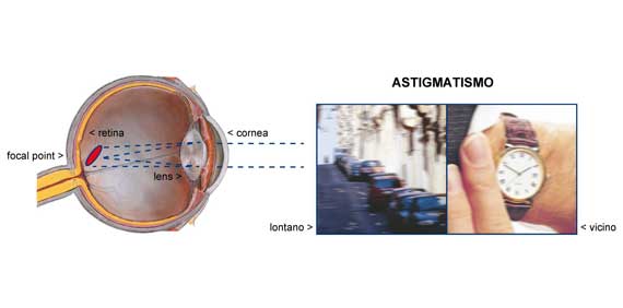 astigmatismo
