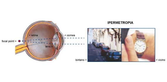 ipermetropia
